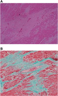 Immune Response in Myocardial Injury: In Situ Hybridization and Immunohistochemistry Techniques for SARS-CoV-2 Detection in COVID-19 Autopsies